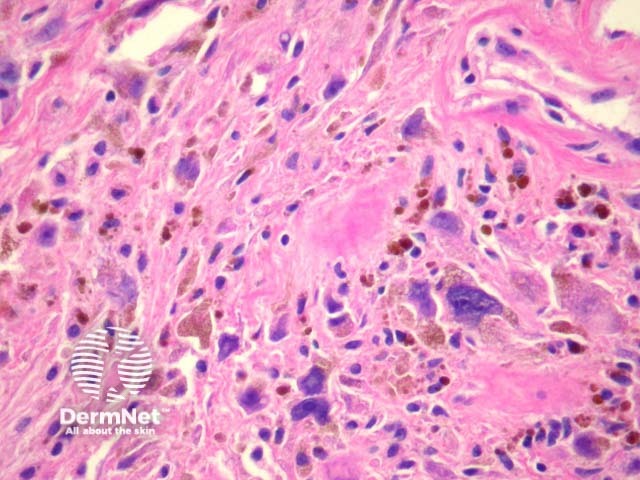 Рисунок 3. Опухолевые веретеновидные клетки с атипичными ядрами и отложениями гемосидерина.