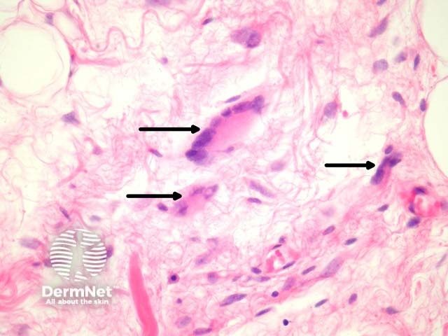 Рисунок 2. Атипичные многоядерные гигантские клетки типа «цветка» (floret cells) с эозинофильной цитоплазмой (указаны стрелками).