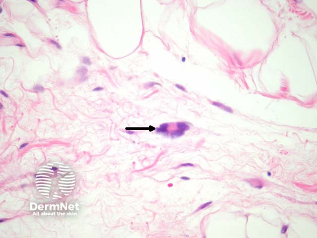 Рисунок 3. Многоядерная гигантская клетка типа «цветка» (floret giant cell) с периферическим расположением ядер (указана стрелкой).