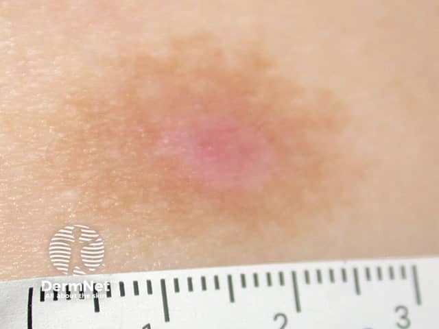 Поствоспалительная гиперпигментация после сеанса фотодинамической терапии
