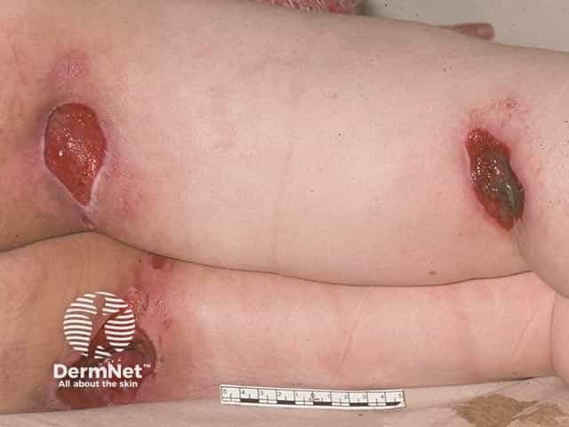 Пролежни в области ягодичной складки и подколенной ямки у пациента в инвалидной коляске со spina bifida