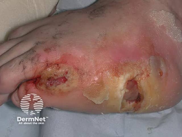 Хроническая декубитальная язва, обусловленная иммобилизацией и утратой чувствительности на фоне spina bifida