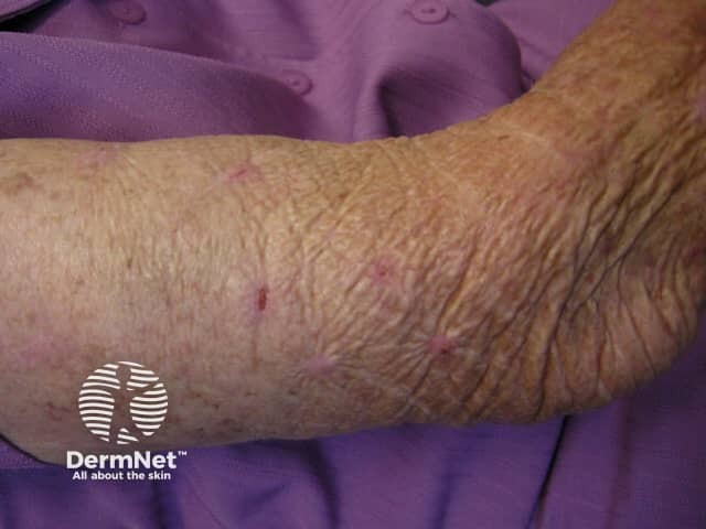 Экскориированное пруриго со следами расчесов