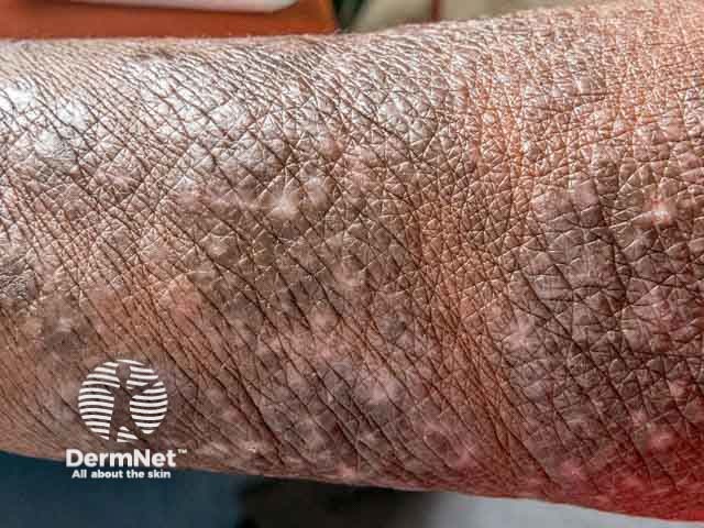 Зудящая папулезная сыпь при ВИЧ-инфекции: выраженные экскориации и папулезные элементы (снимок 00028)