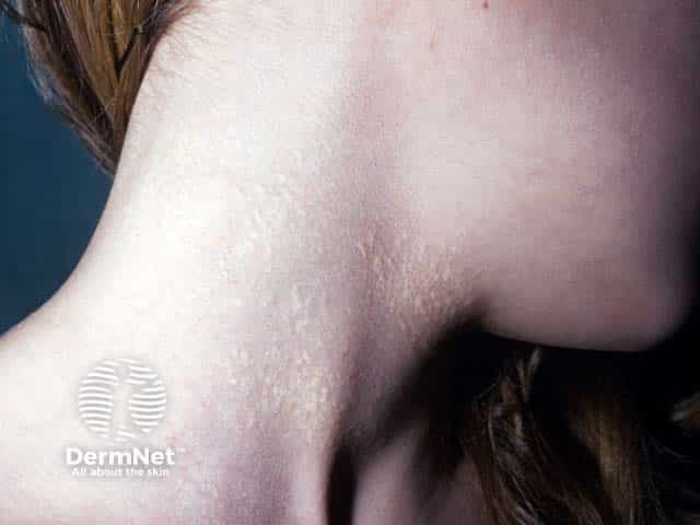 Желтоватые папулы при эластической псевдоксантоме на коже шеи