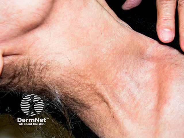 Желтоватые папулы при эластической псевдоксантоме на коже шеи, формирующие характерный рельеф