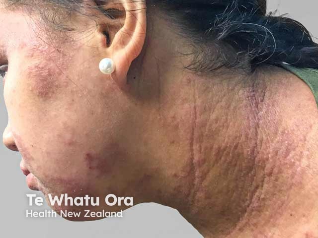 Атопический дерматит у пациентов с темными фототипами кожи (Skin of Colour)