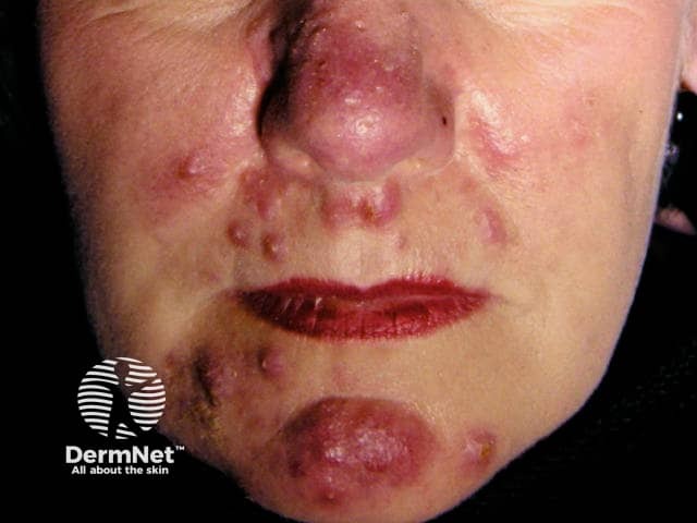 Пиодермия лица, молниеносная розацеа (rosacea fulminans)