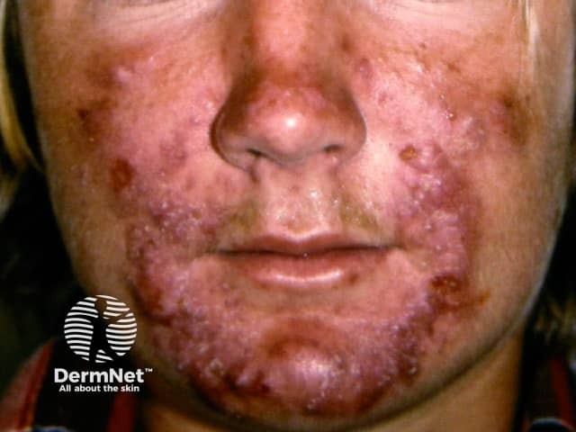 Пиодермия лица, молниеносная розацеа (rosacea fulminans)