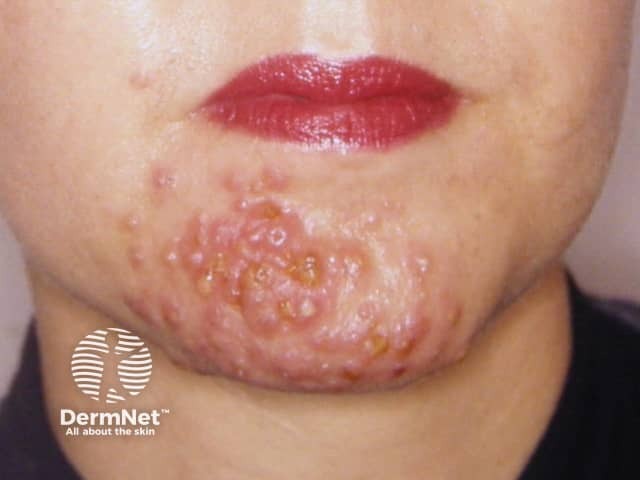 Пиодермия лица, молниеносная розацеа (rosacea fulminans)