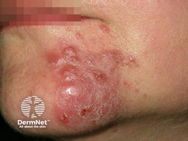 Пиодермия лица, молниеносная розацеа (rosacea fulminans)