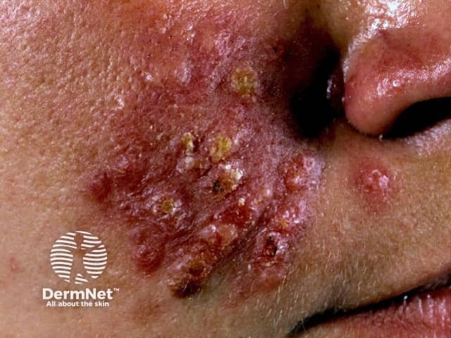 Пиодермия лица, молниеносная розацеа (rosacea fulminans)