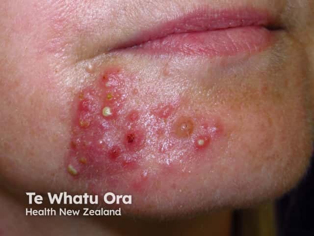 Пиодермия лица, молниеносная розацеа (rosacea fulminans)