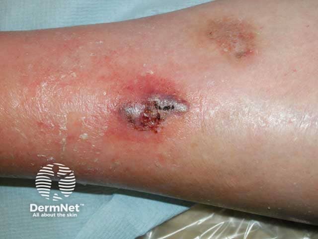 Ранняя стадия гангренозной пиодермии с геморрагическим компонентом