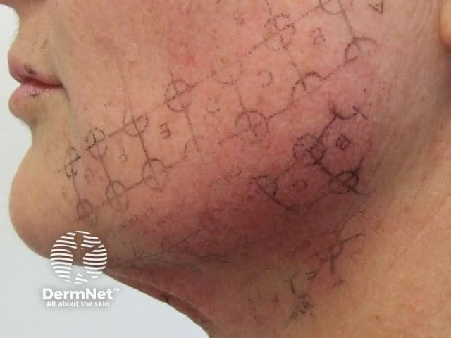 Процедура Thermage®