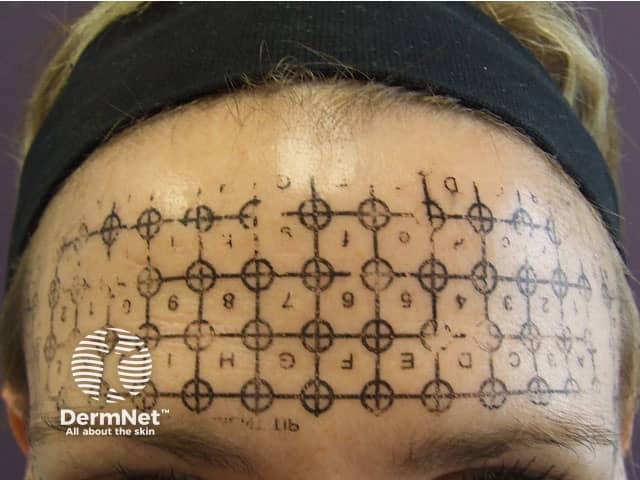 Процедура Thermage®