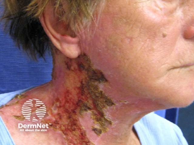 Опоясывающий герпес наружного уха (herpes zoster oticus)
