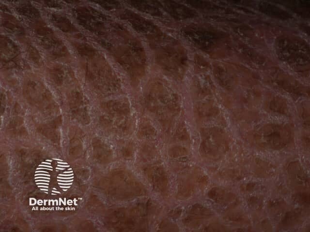 Х-сцепленный рецессивный ихтиоз: типичное шелушение кожи
