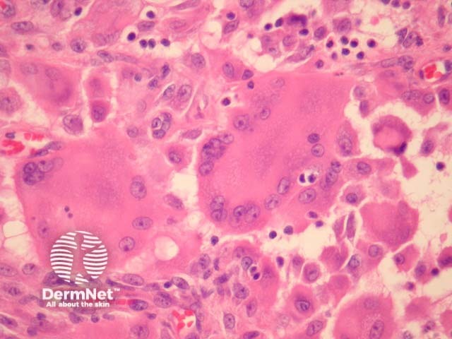 Рисунок 3. Многоядерные клетки с онкоцитарным видом цитоплазмы при большом увеличении.