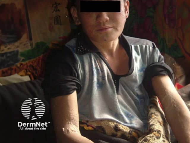 Мультицентрический ретикулогистиоцитоз: Swinfen Charitable Trust