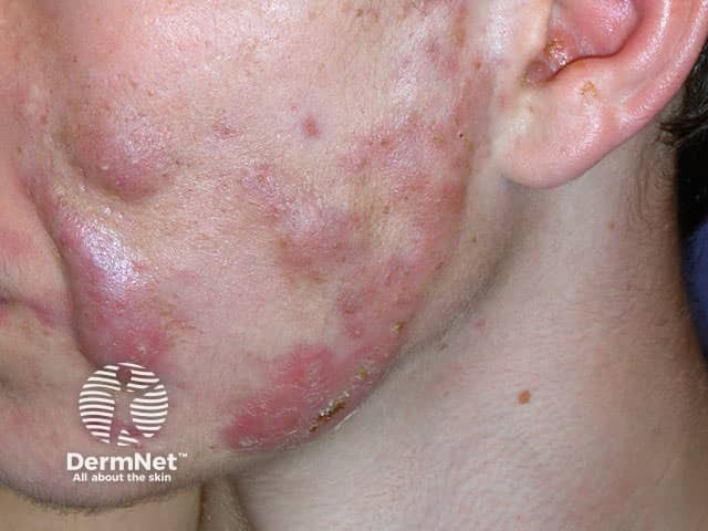 Молниеносные угри (acne fulminans)