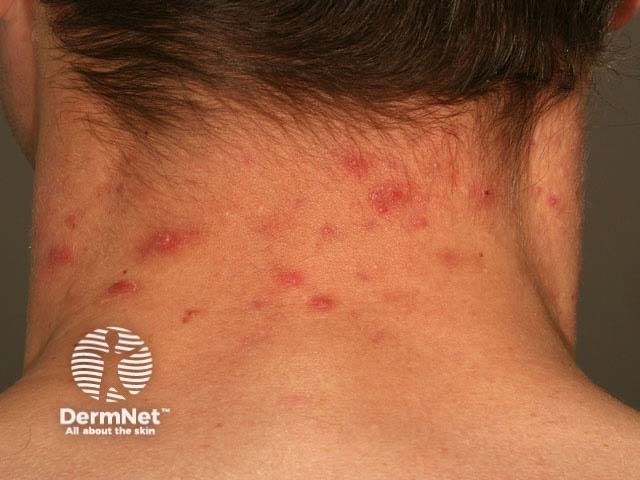 Фолликулит волосистой части головы: воспалительные фолликулярные элементы с формированием корочек