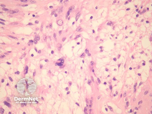 Рисунок 4. Дегенеративные «древние» изменения (ancient schwannoma) с ядерной атипией