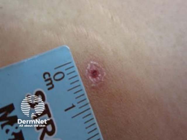 Очаг поражения в процессе заживления