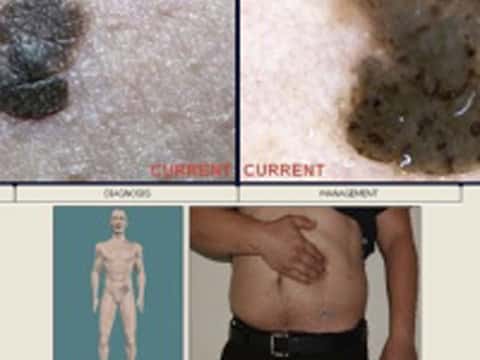 Пигментный невус, зарегистрированный и отмеченный на цифровой карте кожи