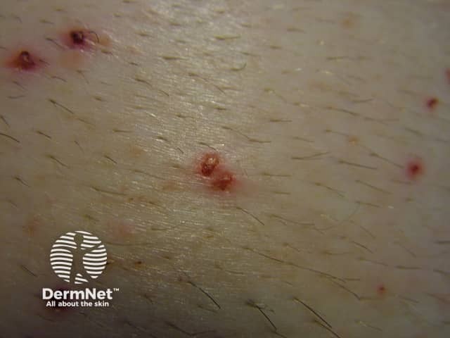 Эритематозно-папулёзная сыпь после предоперационного бритья, крупный план