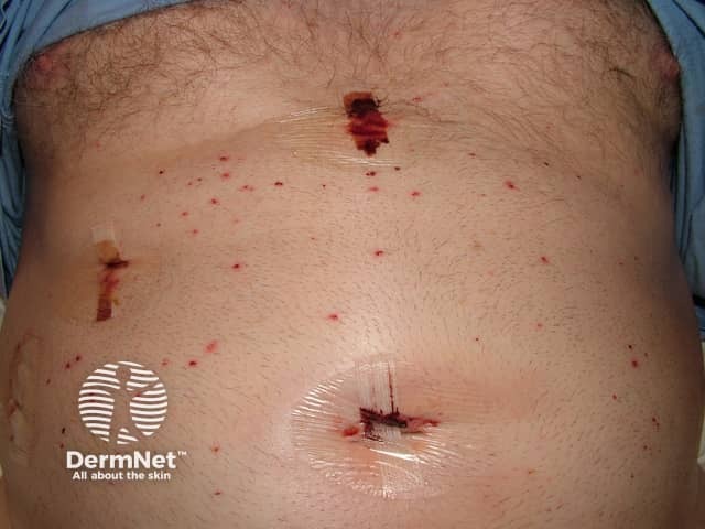 Предоперационное бритьё кожи