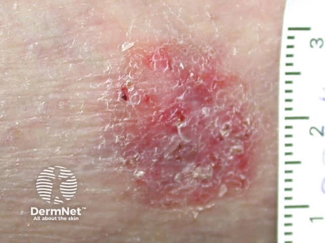 Поверхностная форма базальноклеточного рака