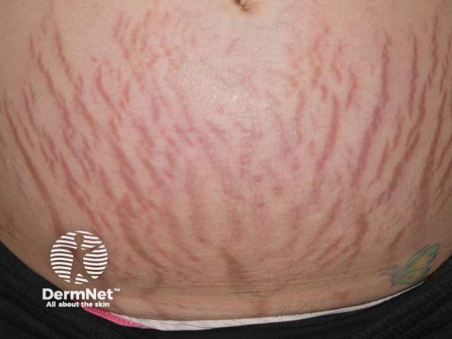 Стрии беременных (striae gravidarum)