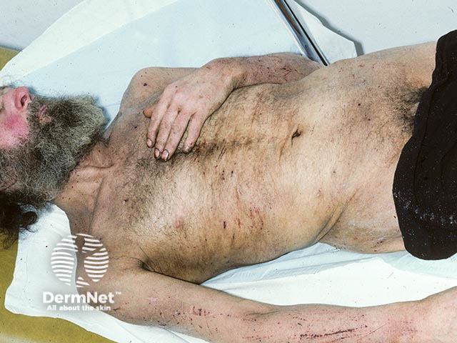 Множественные экскориации вследствие платяного педикулеза