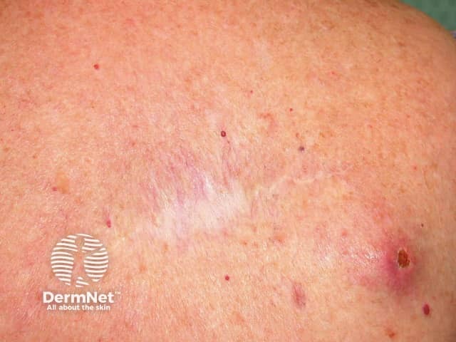 Метастатическая меланома вблизи зоны первичного иссечения