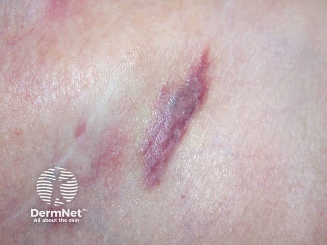 Метастазы рака молочной железы в кожу