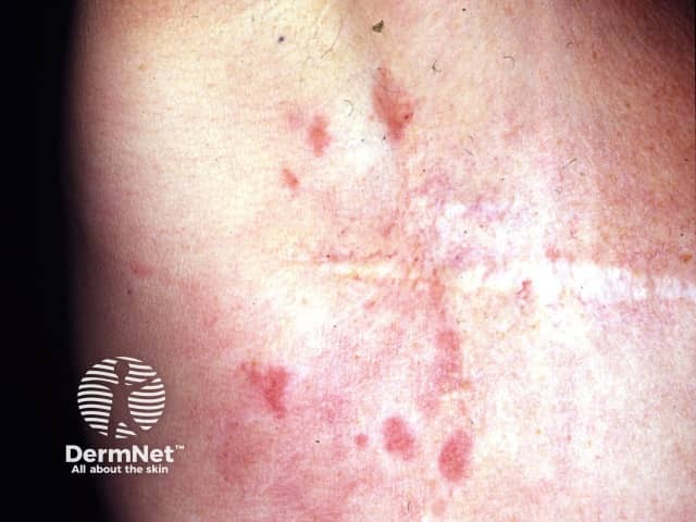Метастатическое поражение кожи при раке молочной железы