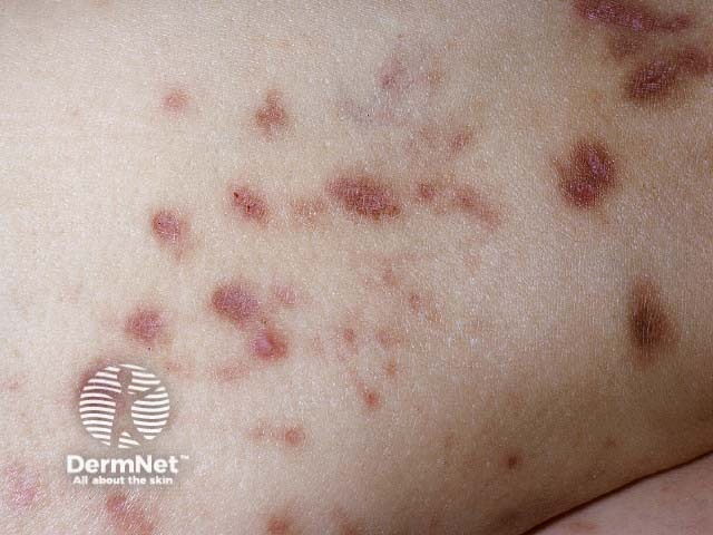 Диабетическая дермопатия
