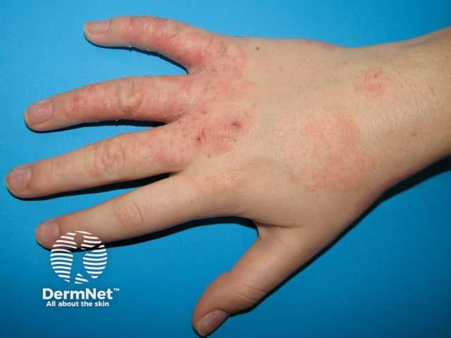 Простой раздражительный дерматит кистей («экзема домохозяек»)
