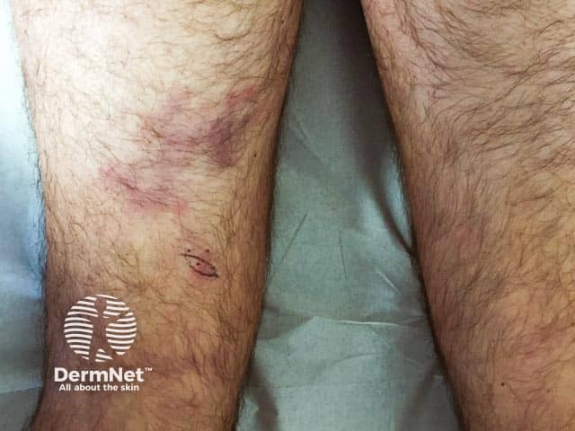 Сетчатое ливедо (livedo reticularis) развилось в результате васкулита сосудов среднего калибра; сопутствующий церебральный васкулит привел к коме