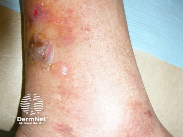 Пузыри у данного пациента обусловлены диабетическим буллёзом (bullosis diabeticorum); кома развилась вследствие гипергликемии