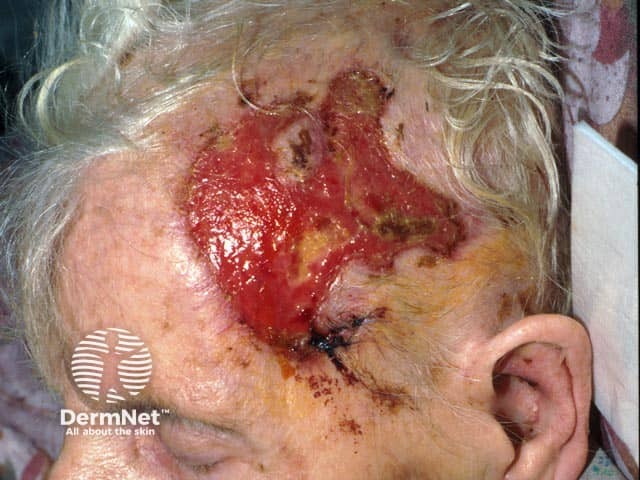 Прогрессирующая язва в височной области у этой пациентки была следствием височного артериита, приведшего к потере зрения и, в конечном итоге, к коме