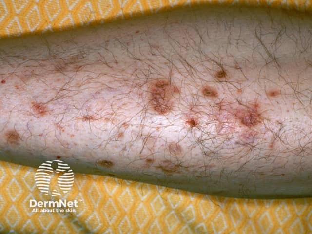 Диабетические пятна на голенях (диабетическая дермопатия) послужили ключом к диагностике сахарного диабета у этого пациента в коме