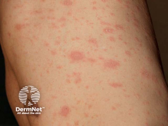 Розовый лишай Жибера (Pityriasis rosea)