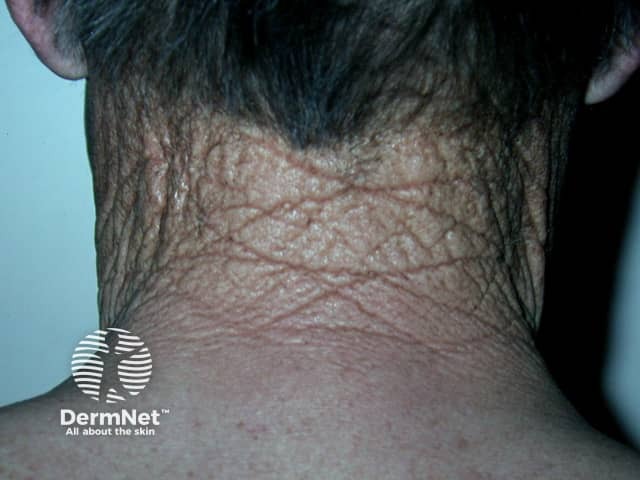 Ромбовидная кожа затылка (cutis rhomboidalis nuchae), часто ассоциированная с синдромом Фавра–Ракушо