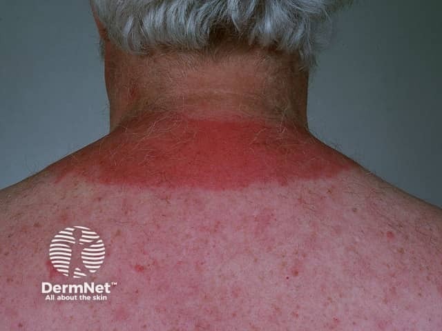 Солнечная крапивница: уртикарные высыпания после инсоляции