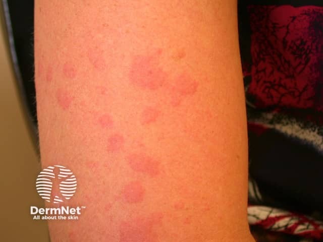 Солнечная крапивница: эритематозные волдыри на открытых участках кожи