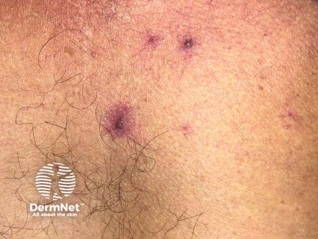 Телеангиэктазии у пациента с циррозом печени