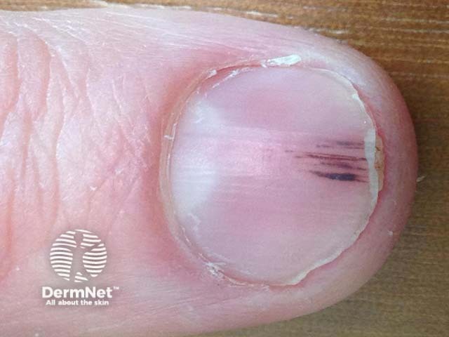Онихопапиллома со щепковидными кровоизлияниями