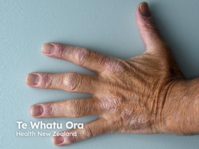Псориаз тыльной поверхности кисти